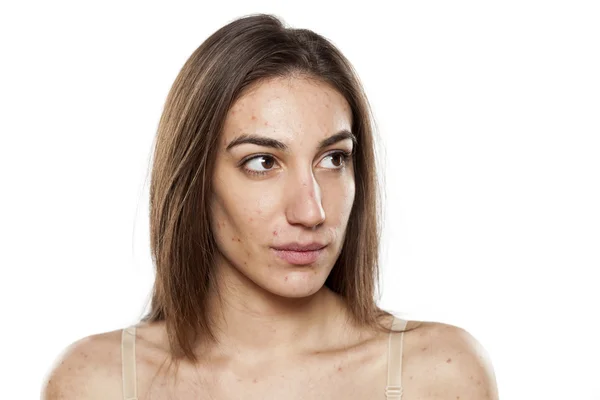 Women with problematic skin — Stock Photo, Image