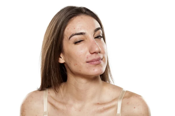 Mulheres com pele problemática — Fotografia de Stock