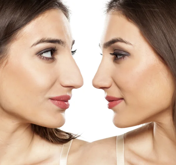 Before and after rhinoplasty — Stock Photo, Image