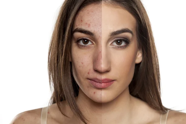 Problematic skin before and after makeup — Stock Photo, Image