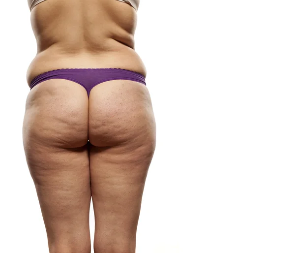 Obese female buttocks — Stock Photo, Image