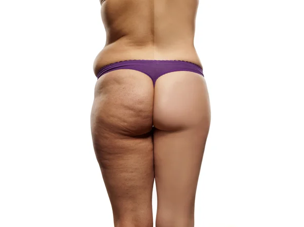 Before and after liposuction — Stock Photo, Image