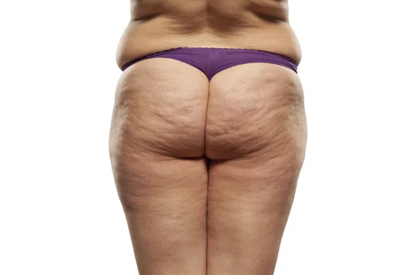 Obese female buttocks — Stock Photo, Image