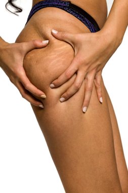 Woman pinching stretch marks and cellulite on her leg on white background clipart
