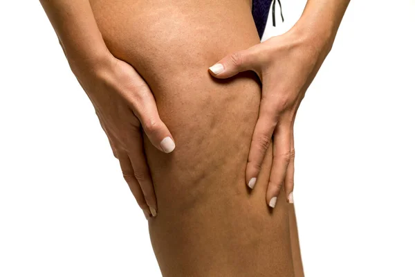 Woman Pinching Stretch Marks Cellulite Her Leg White Background — Stock Photo, Image