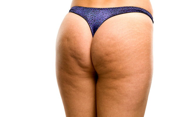 Female buttocks with cellulite and stretch marks on white background