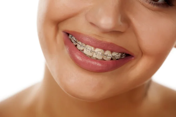 Sonriente boca femenina con aparatos ortopédicos —  Fotos de Stock