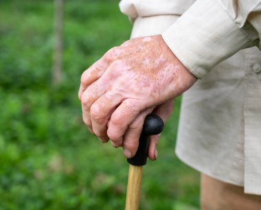 Vitiligo pigmentleri olan erkek ellerini kapalı tut.