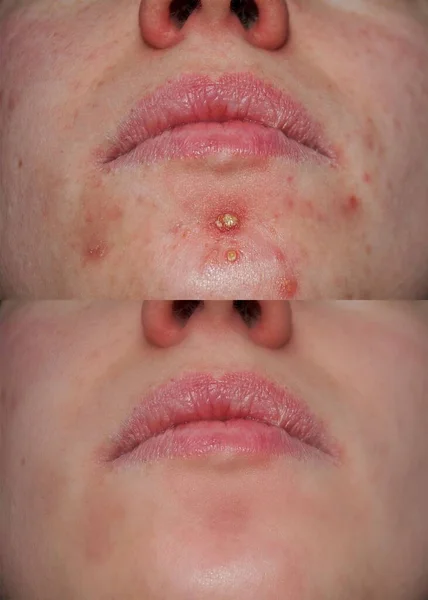 Photo with and without acne. Problem skin and beauty concept blackheads on skin of nose and spot melasma pigmentation skin on facial. Photos before and after treatment.