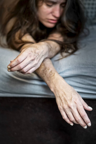 Самоповреждение расстроенной, разочарованной больной женщине, лежащей в постели с тяжелыми порезами и шрамами от самоувечья в разочаровании, самоуничижении, пограничном расстройстве личности, копировании пространства