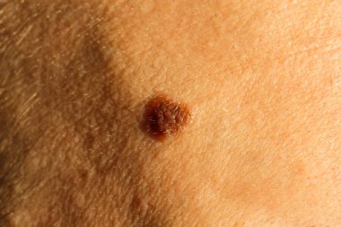 Alnında ben, kafatasının kıvrımında gölge. Dermatoloji, sağlıklı cilt için melanin. Deri hastalıkları, sivilceler