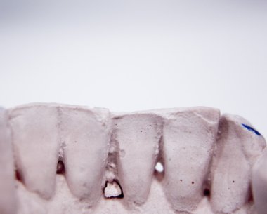 Diş Protez kil diş kalıp