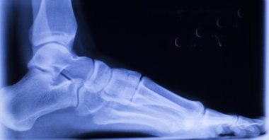 Foot and toes injury xray scan clipart