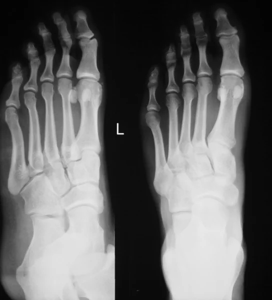발과 발가락 부상 엑스레이 검사 — 스톡 사진