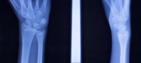 Mano dedos pulgar muñeca rayos X escanear —  Fotos de Stock