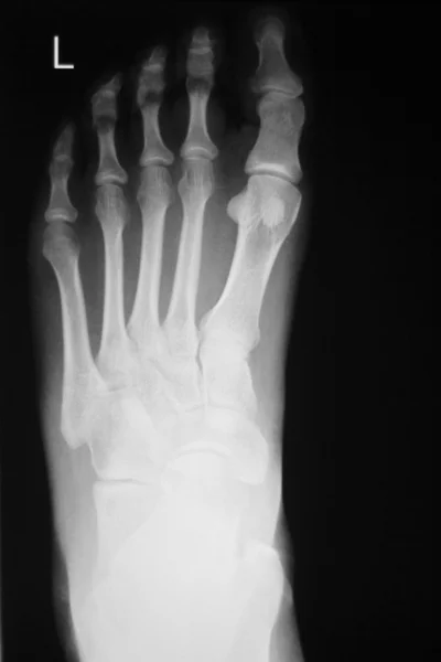 Verletzungen an Fuß und Zehen Röntgenbild — Stockfoto