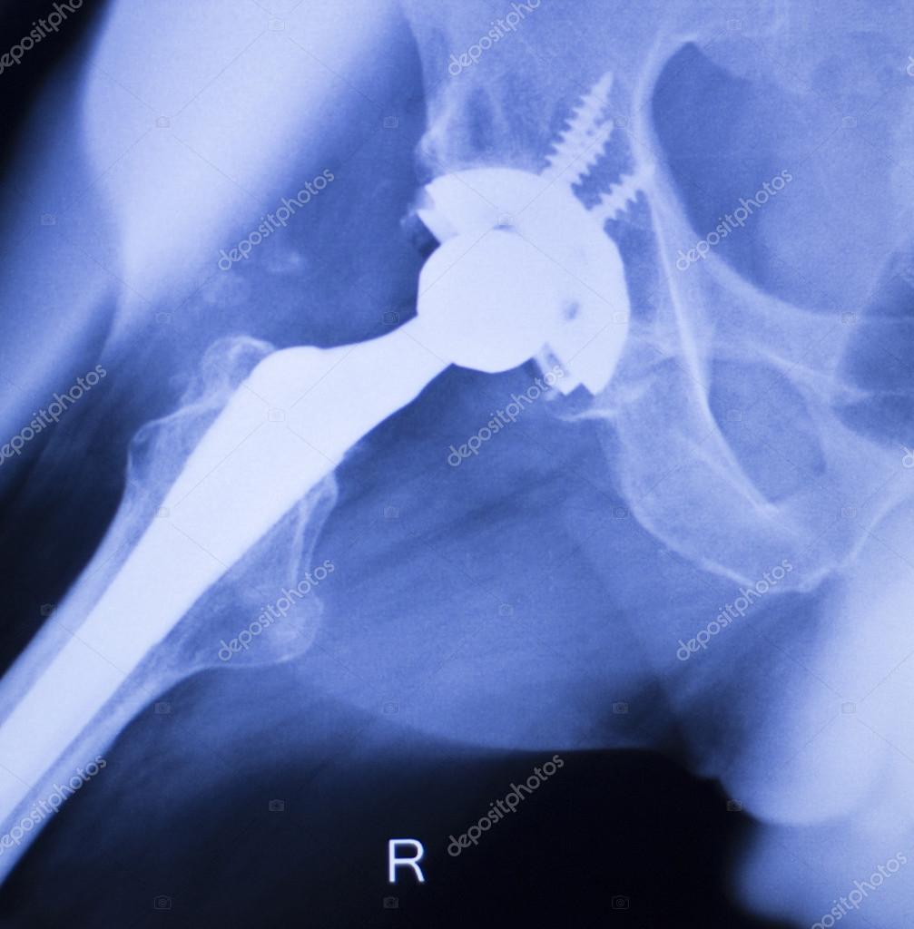 Hip replacement xray orthopedic medical scan Stock Photo by