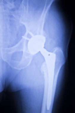 Kalça protezi xray ortopedi tıbbi tarama