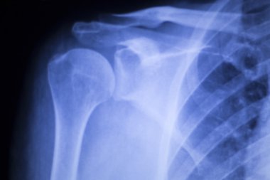 Omurga omur kaburga yaralanması xray tarama geri