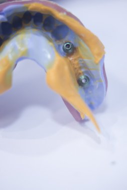 Diş kalıp diş izlenim plaka