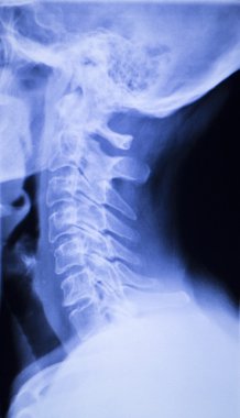 Kafatası boyun omurga omuz xray inceden inceye gözden geçirmek