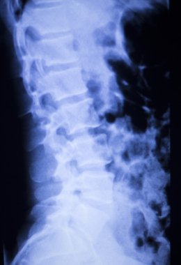 Omurga omur sırt yaralanması xray tarama