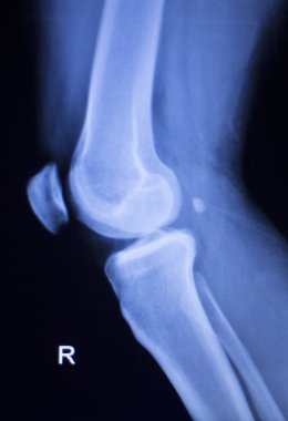 Diz ve Menisküs yaralanma xray tarama