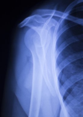 Omurga omur kaburga yaralanması xray tarama geri
