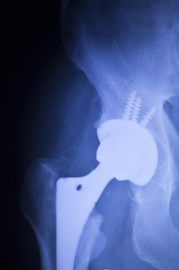 Kalça protezi xray ortopedi tıbbi tarama