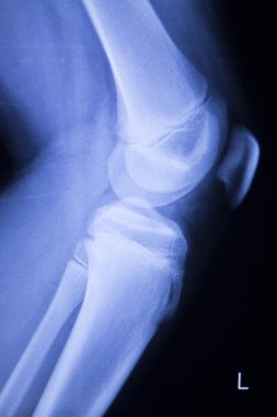 Diz ve Menisküs yaralanma xray tarama