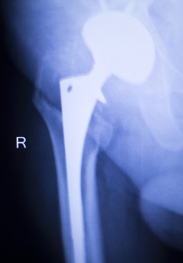 Kalça protezi xray ortopedi tıbbi tarama