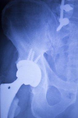 Kalça protezi xray ortopedi tıbbi tarama