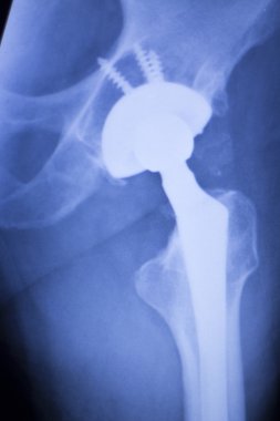Kalça protezi xray ortopedi tıbbi tarama