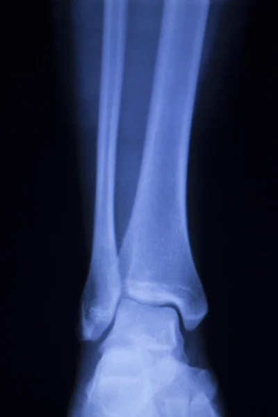 Shin bacak ayak bileği yaralanması xray inceden inceye gözden geçirmek — Stok fotoğraf