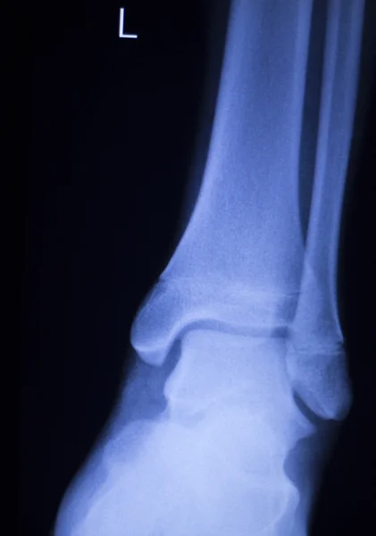 Shin ben ankel skada xray scan — Stockfoto