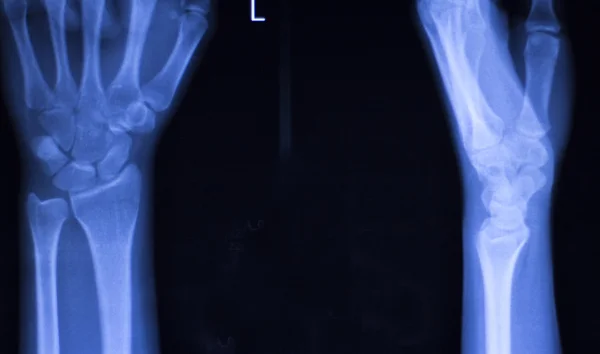 손 손가락 손가락 손목 엑스레이 검사 — 스톡 사진