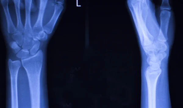 Mão dedos polegar pulso xray varredura — Fotografia de Stock