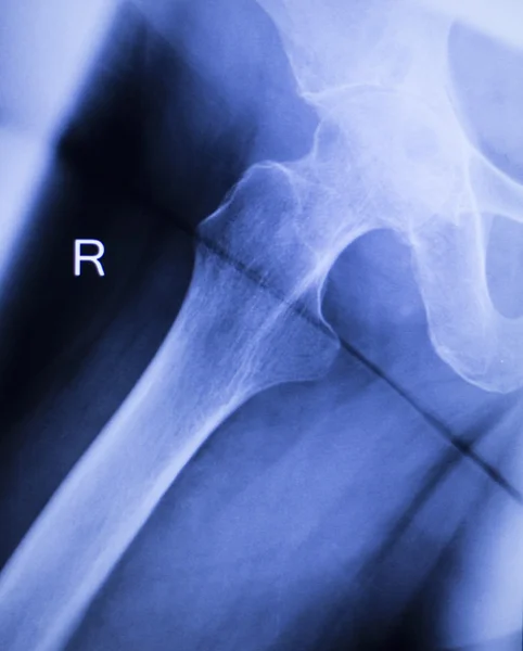 Röntgenbild der Hüftverletzung — Stockfoto