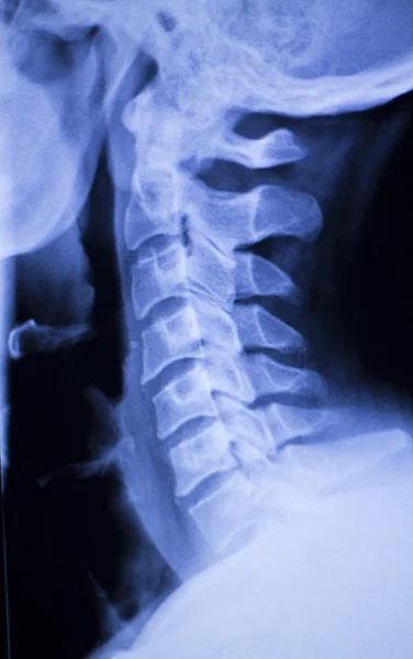 Schedel hals wervelkolom schouders xray scan — Stockfoto