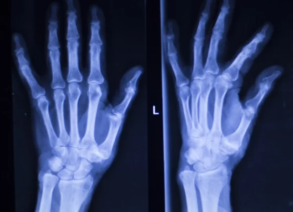Mão dedos polegar pulso xray varredura — Fotografia de Stock