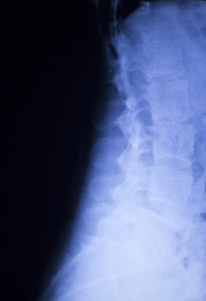다시 척추 통증 부상 엑스레이 검사 — 스톡 사진
