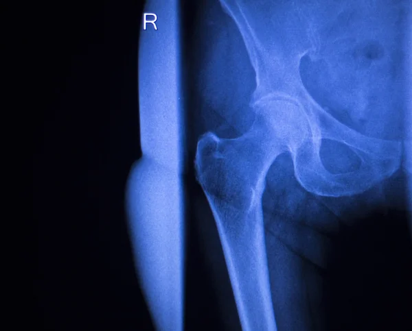 Lésion de la hanche radiographie médicale — Photo