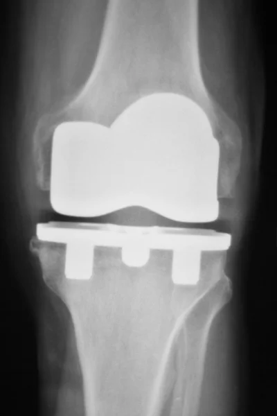 Exploración de rayos X de implante ortopédico de rodilla — Foto de Stock
