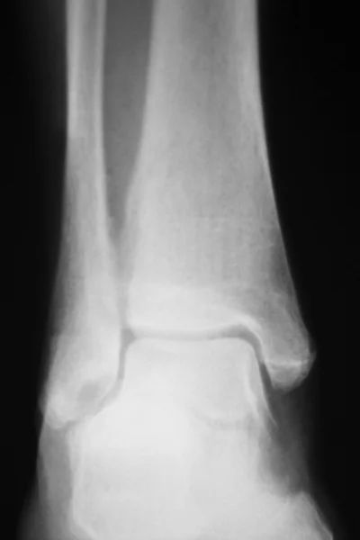 Рентген лодыжки голени — стоковое фото