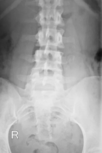 Spine vertebra back injury xray scan