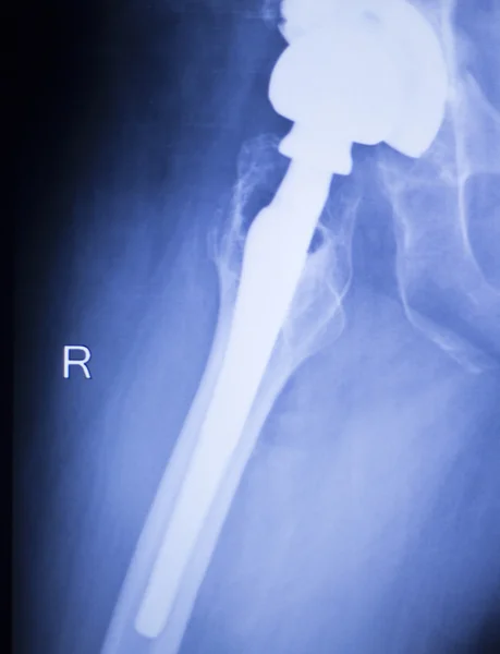 Radiografía de reemplazo de cadera exploración médica ortopédica —  Fotos de Stock