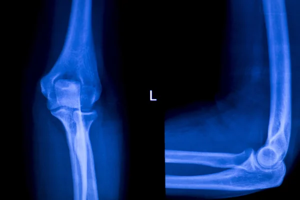前臂的手臂和肘关节 x 射线扫描 — 图库照片