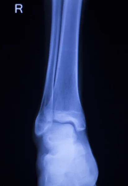 Shin noha kotník poranění xray skener — Stock fotografie