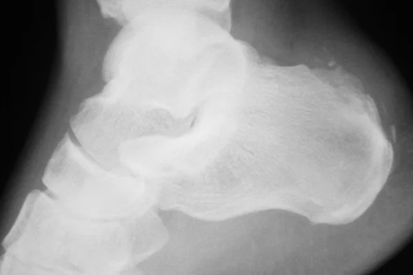 Foten hälen vrist skada xray scan — Stockfoto