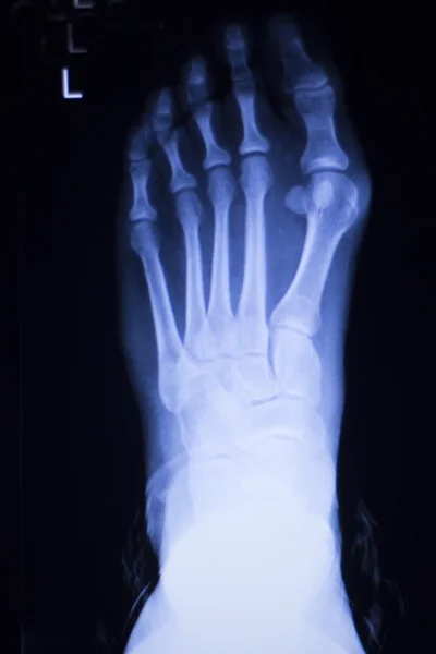 Foot and toes injury xray scan — Stock Photo, Image